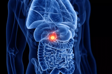 cancer de la vésicule biliaire cancer de la vésicule biliaire
